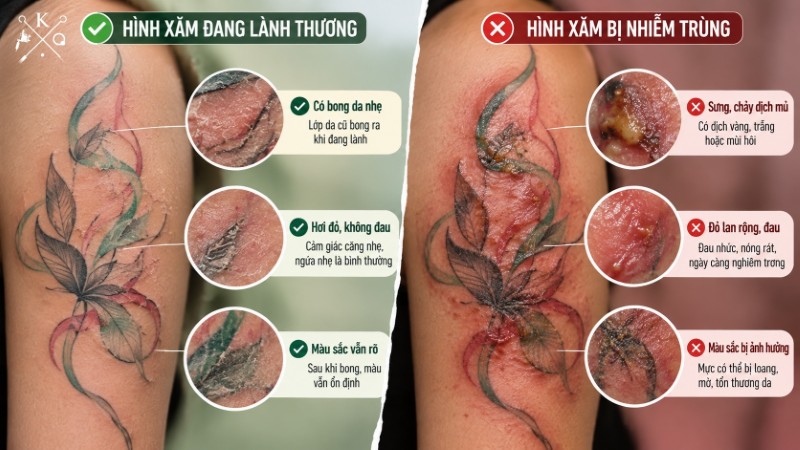 So sánh hình xăm đang lành thương và hình xăm có dấu hiệu nhiễm trùng So sánh hình xăm đang lành thương và hình xăm có dấu hiệu nhiễm trùng