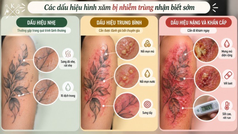 Các dấu hiệu hình xăm có thể bị nhiễm trùng cần chú ý Các dấu hiệu hình xăm có thể bị nhiễm trùng cần chú ý