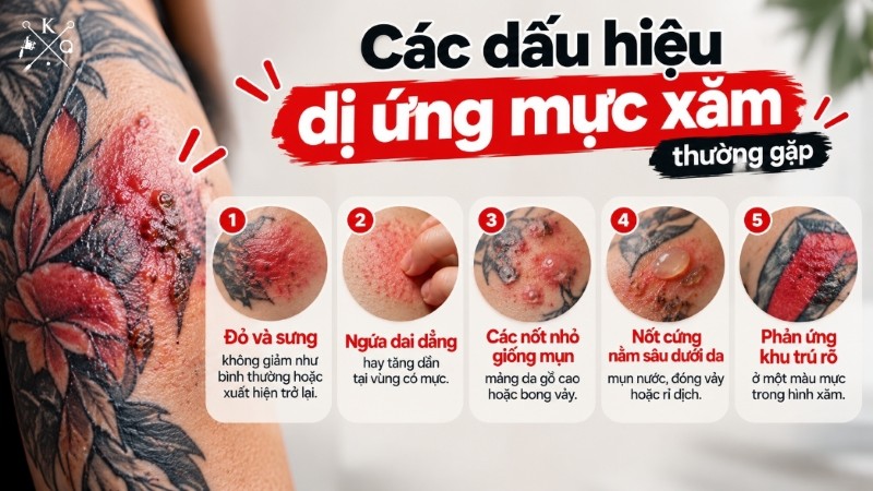 Dấu hiệu dị ứng mực xăm như ngứa, nổi nốt và da gồ cao